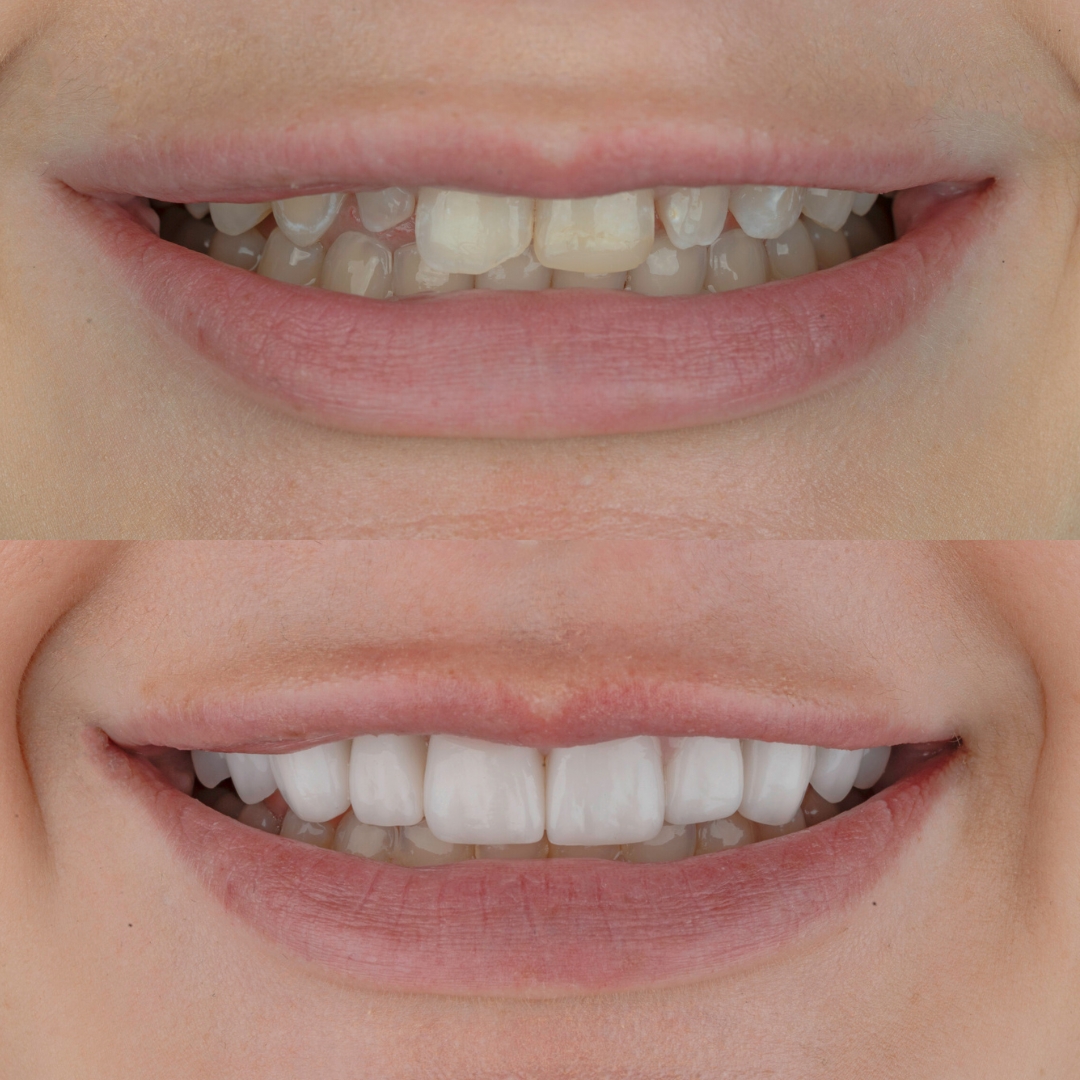 Before and after porcelain veneers correcting uneven teeth
